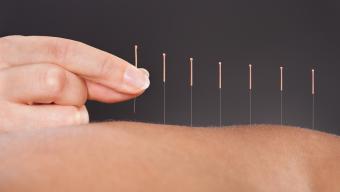 acupuncture